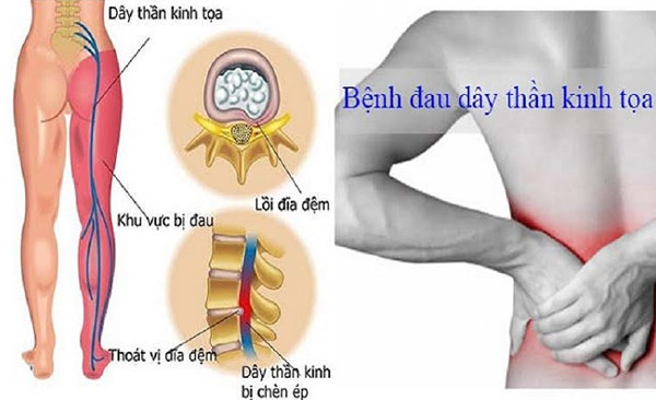 Đau thần kinh tọa là một yếu tố bệnh lý phổ biến gây đau lưng không cúi được